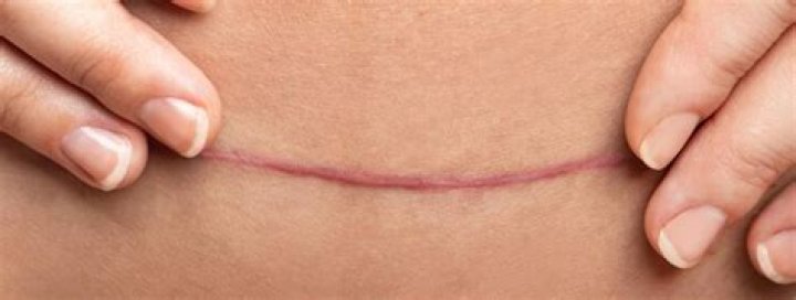 Do you get stitches or glue after C-section?