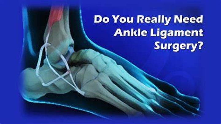 Do you need surgery for a torn ligament in your foot?