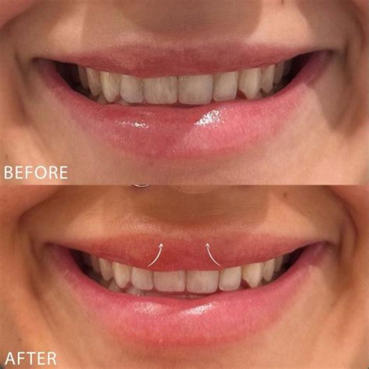 Does a lip flip show more teeth?