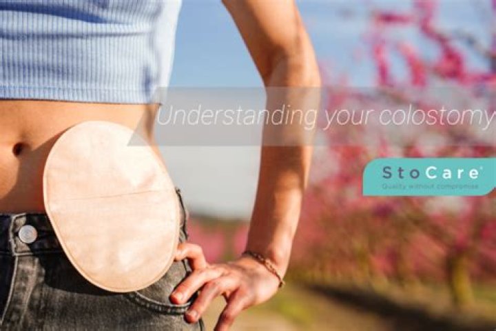 Does a stoma shorten your life?