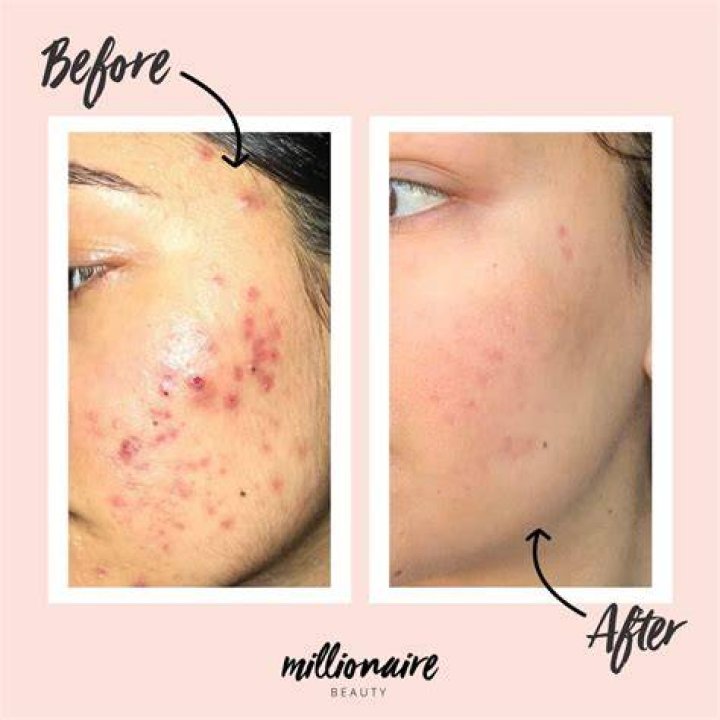 Does acne look worse after shower?