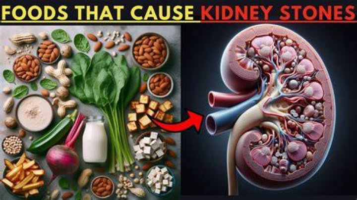 Does almond milk cause kidney stones?