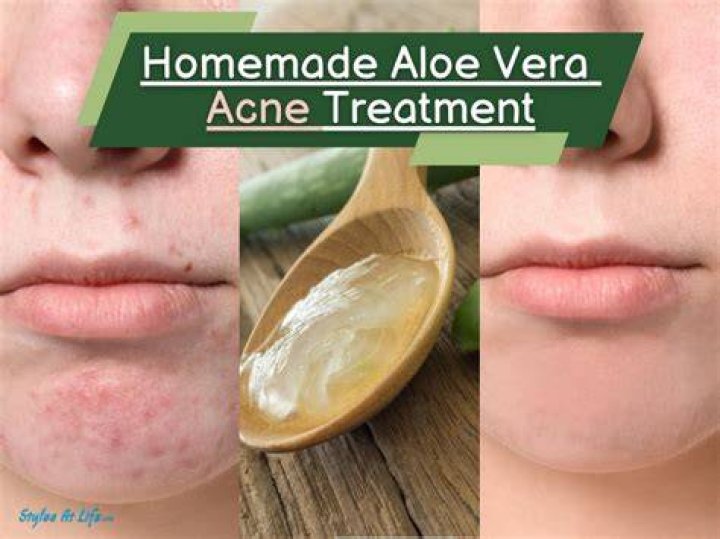 Does aloe vera remove pimple marks?