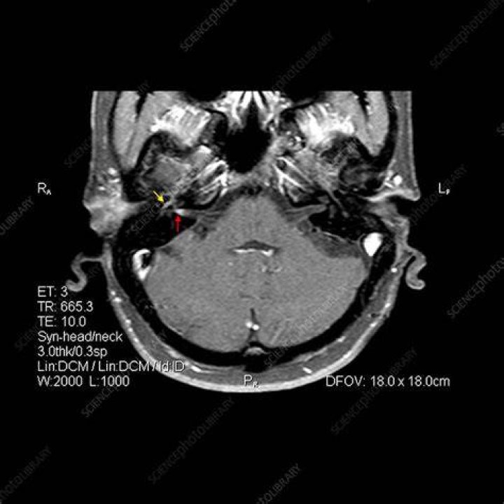 Does Bells Palsy show on an MRI?
