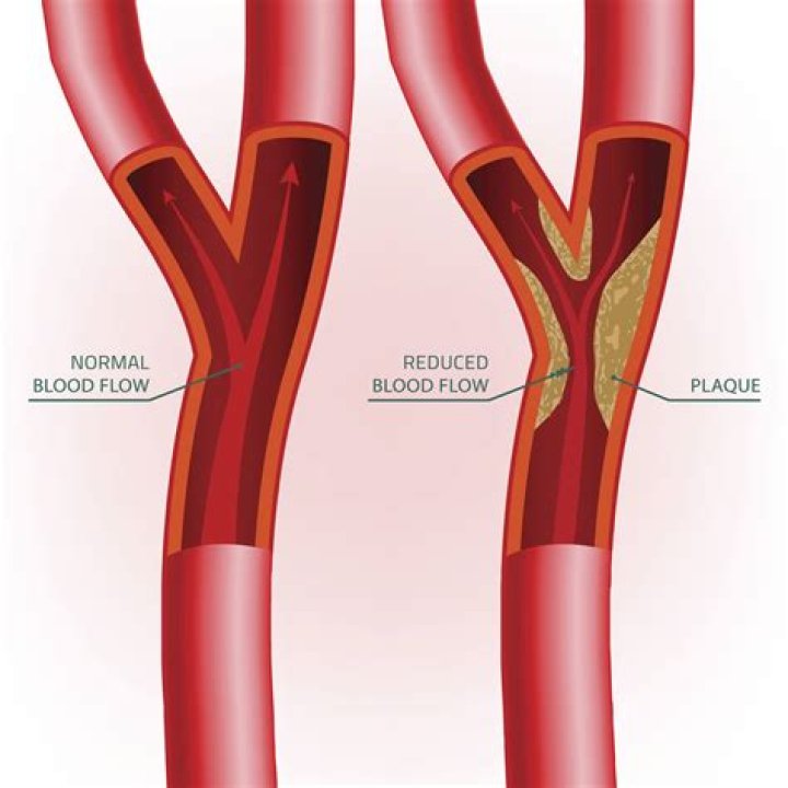 Does black tea remove plaque from arteries?