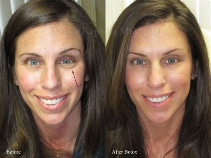 Does Botox make your eyes look farther apart?