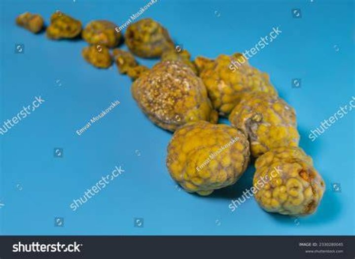 Does cholesterol come out in poop?