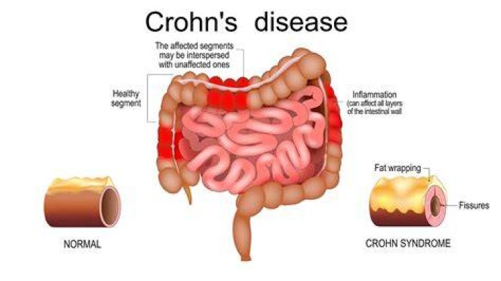 Does Crohn's cause scar tissue?
