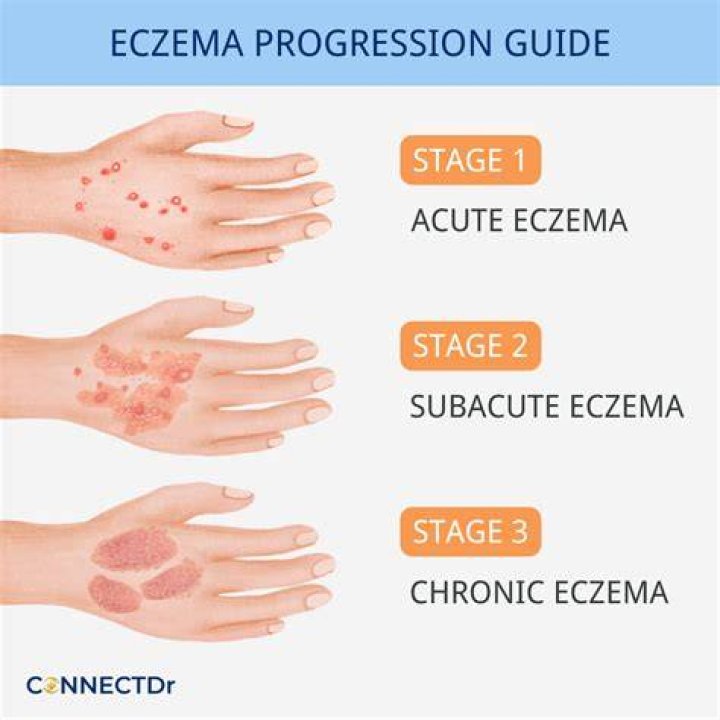 Does eczema get worse as you age?