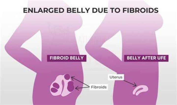 Does enlarged uterus cause big belly?