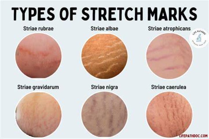 Does exercise make stretch marks worse?