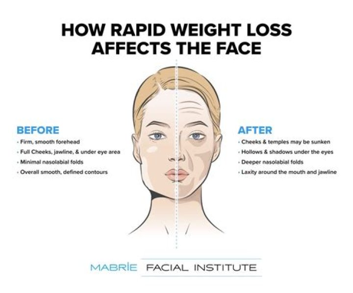Does face shape change with weight loss?