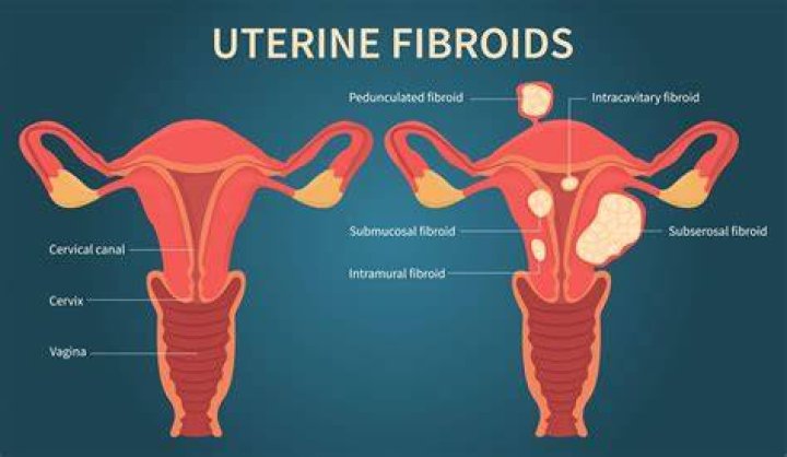 Does fibroid affect ovulation?
