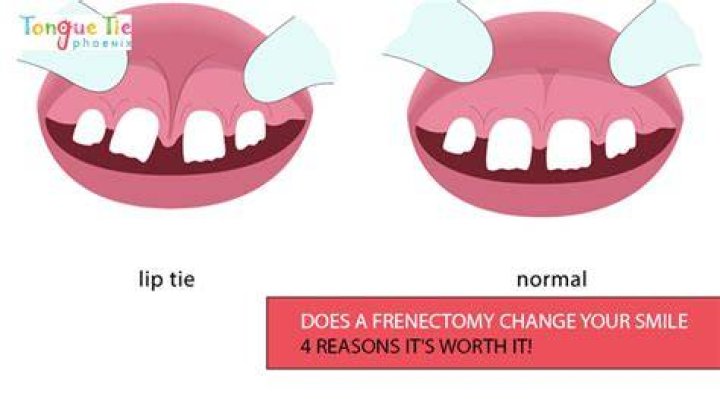 Does frenectomy affect smile?