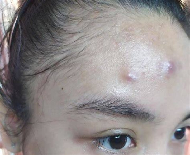 Does hot water help blind pimples?