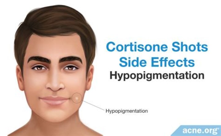 Does hydrocortisone help hypopigmentation?
