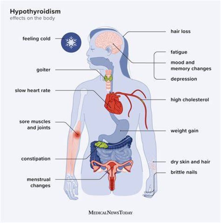 Does hypothyroidism affect sleep?