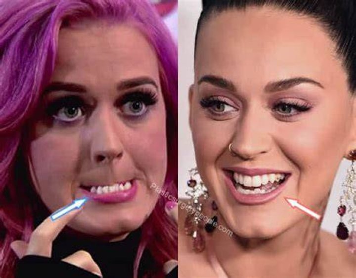 Does Katy Perry have crooked bottom teeth?