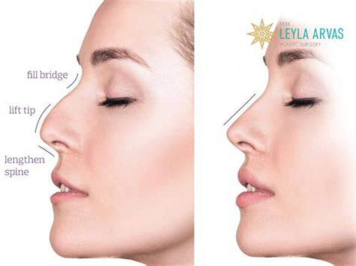 Does lip lift affect nose tip?