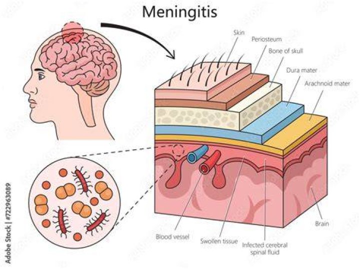 Does meningitis show up in blood work?