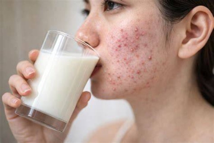 Does milk cause Hairfall?