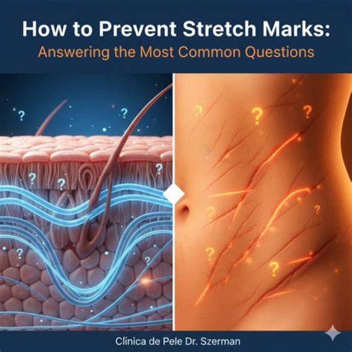 Does Moisturising prevent stretch marks?