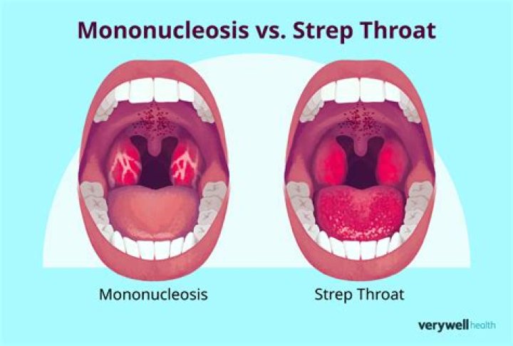 Does mono look like strep?