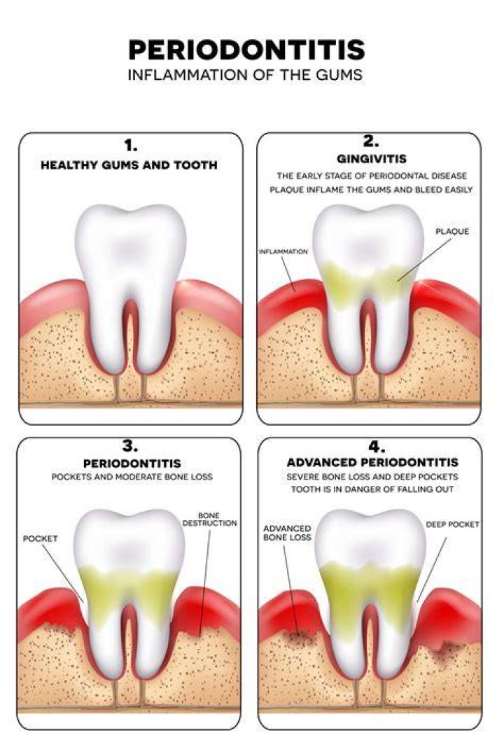 Does periodontitis hurt?