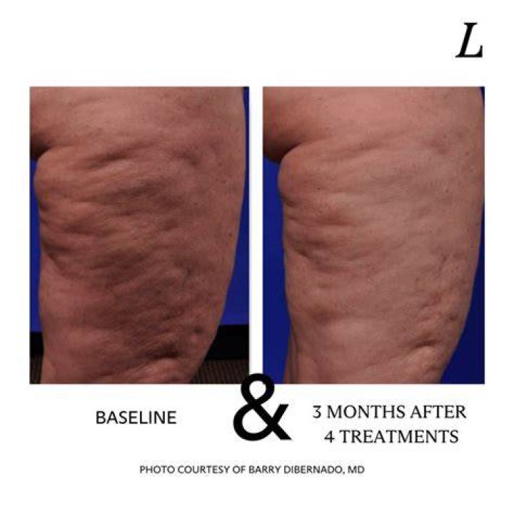 Does Preparation H reduce cellulite?