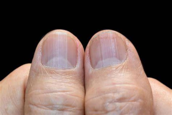 Does RA affect fingernails?