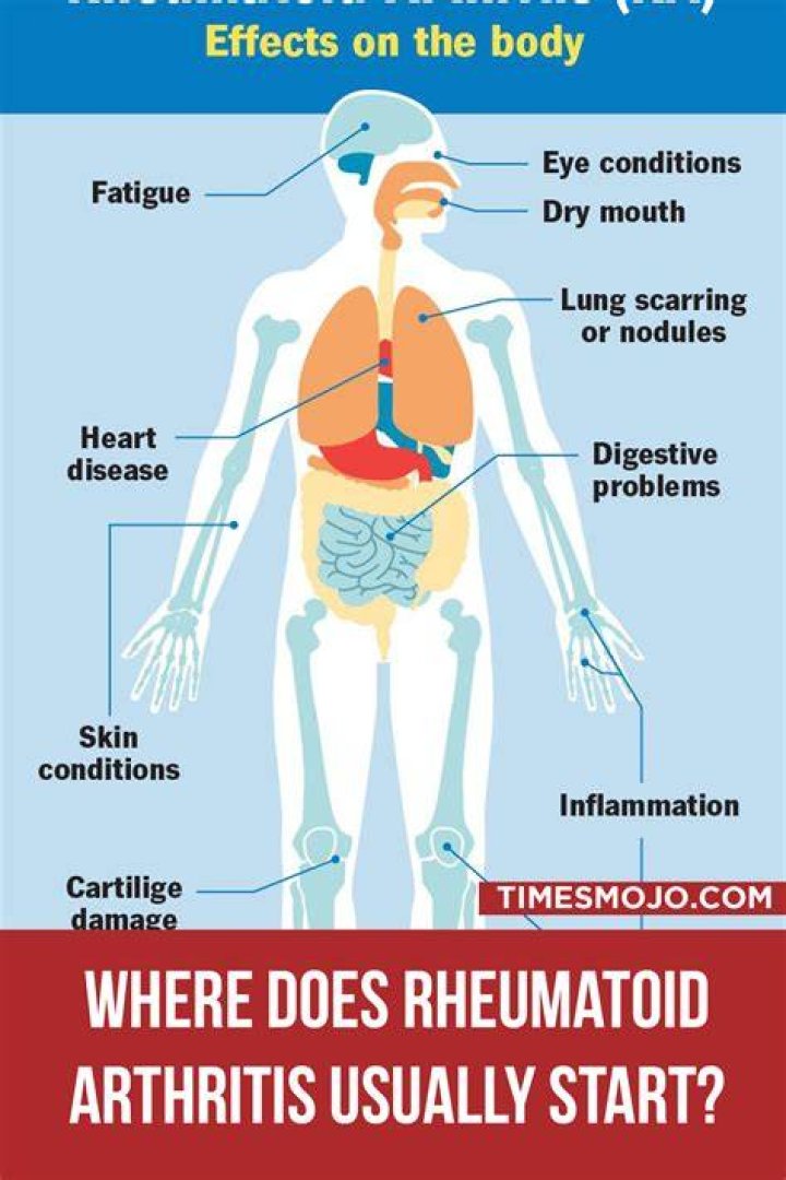Does rheumatoid arthritis hurt all day?