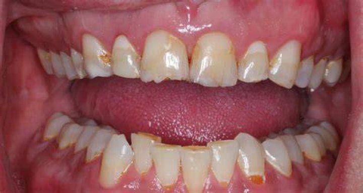Does running affect your teeth?