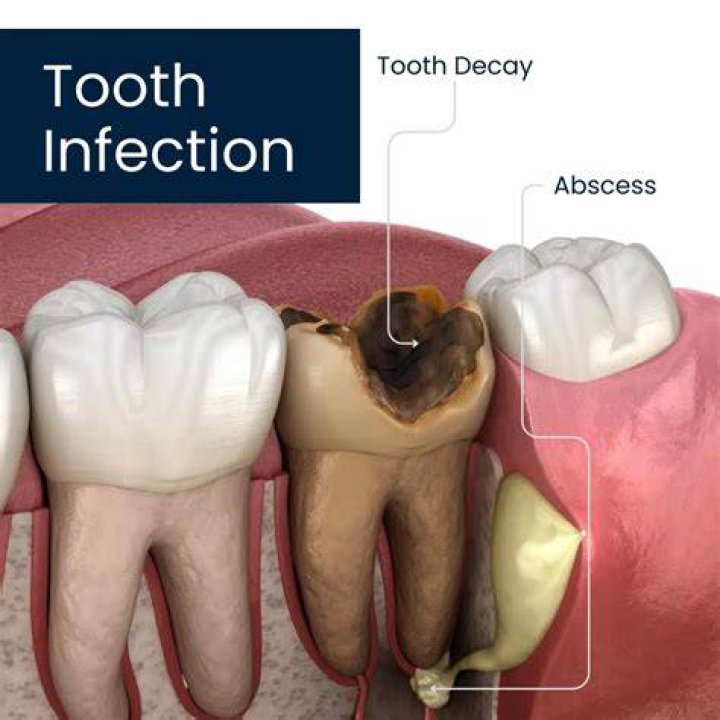 Does salt draw out infection in tooth?