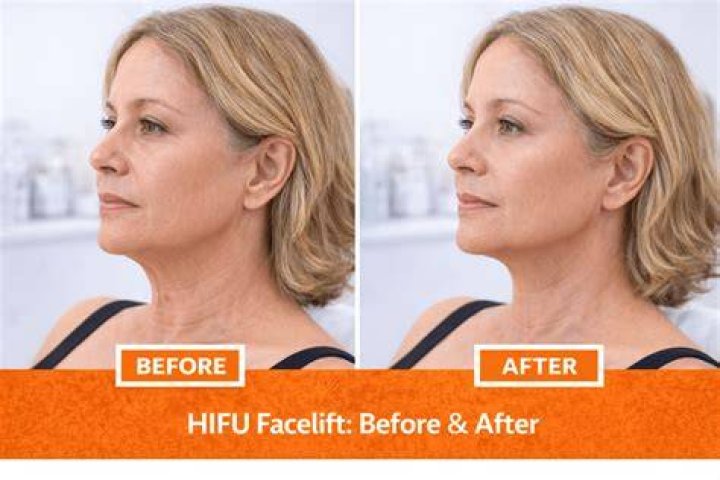 Does skin continue to tighten after facelift?