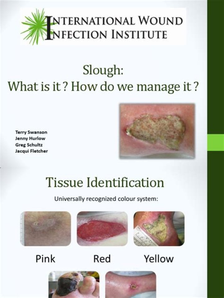 Does Slough mean infection?