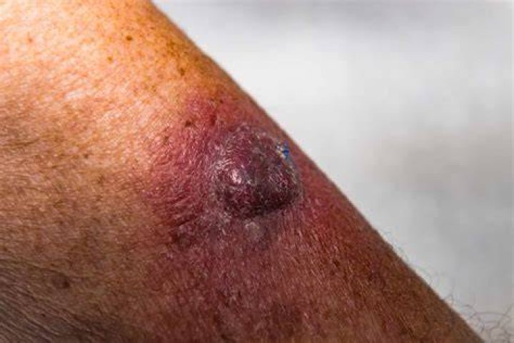 Does squamous cell carcinoma look like a wart?