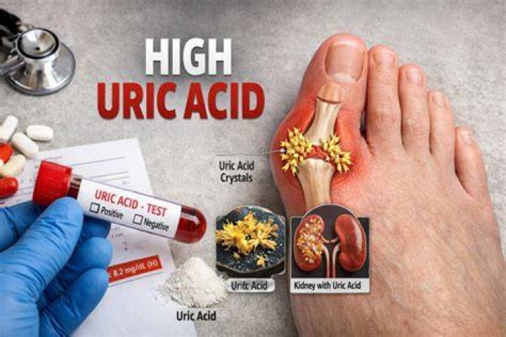 Does sweating release uric acid?