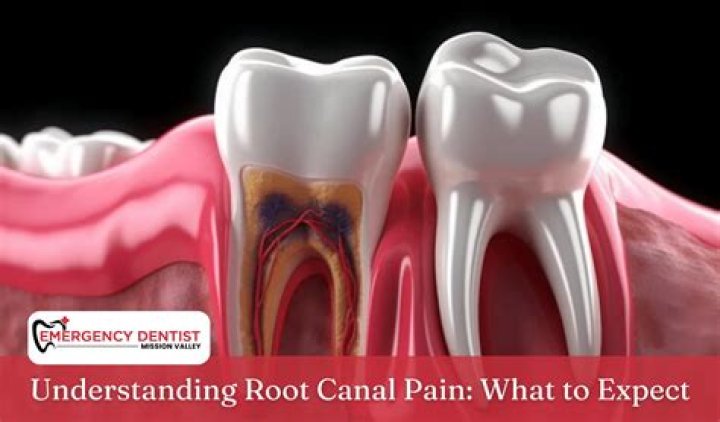Does the 2nd part of a root canal hurt?
