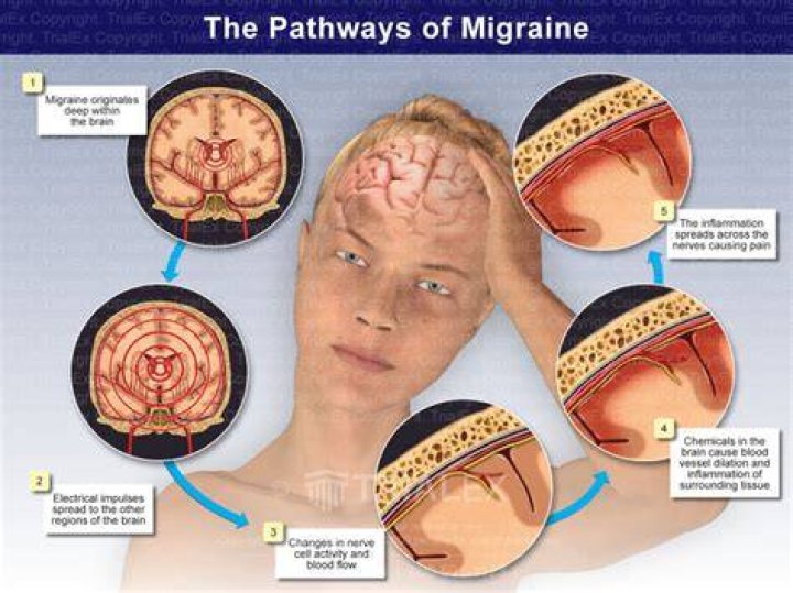 Does the brain swell during a migraine?