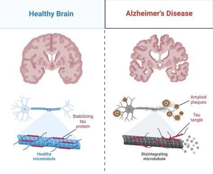Does tinnitus lead to Alzheimer's?