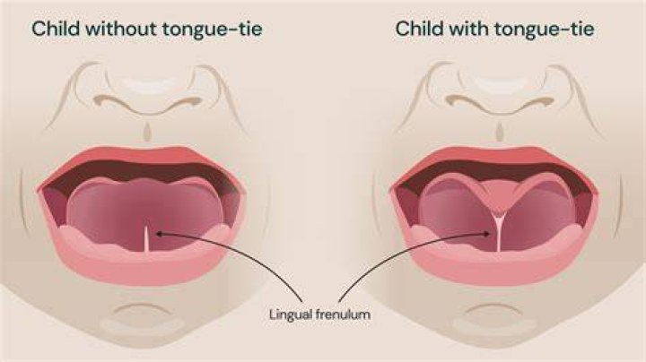 Does tongue-tie go away?