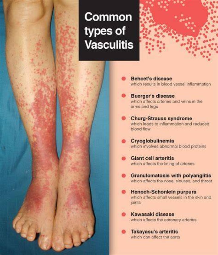 Does vasculitis cause blisters?