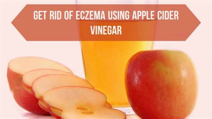 Does vinegar get rid of eczema?
