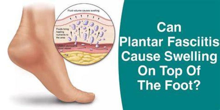 Does your foot swell with plantar fasciitis?