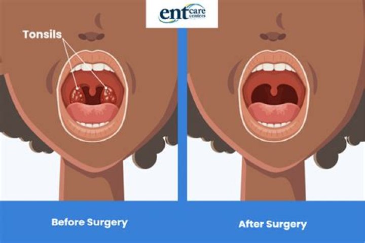 Does your voice change after tonsil removal?
