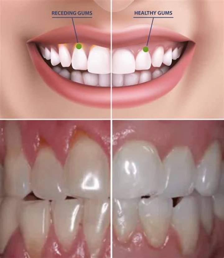 How can I restore my gums?