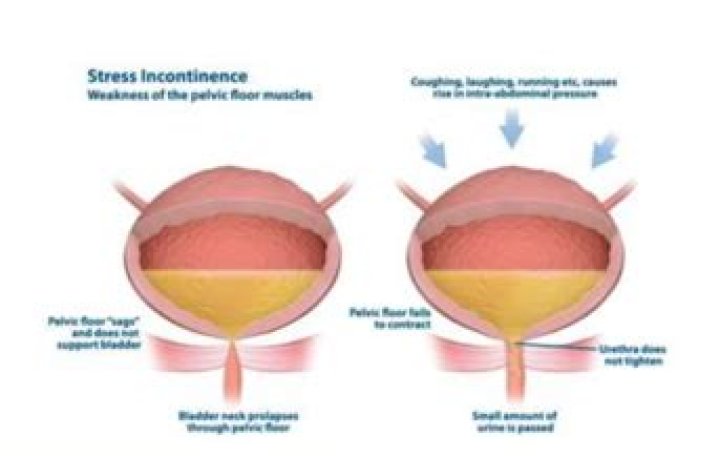 How can I stop stress incontinence?