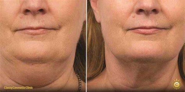 How can I tighten my sagging chin?