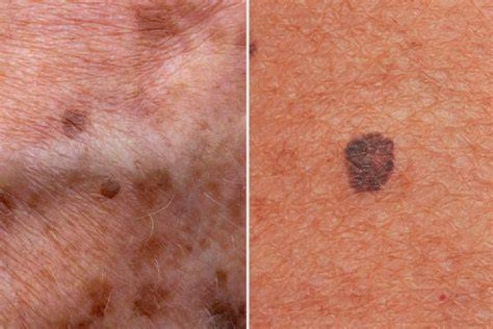 How can you tell if age spots are cancerous?
