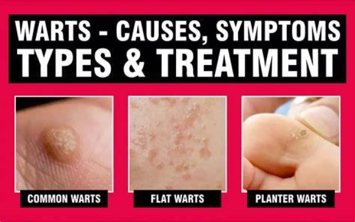How can you tell if its a wart?